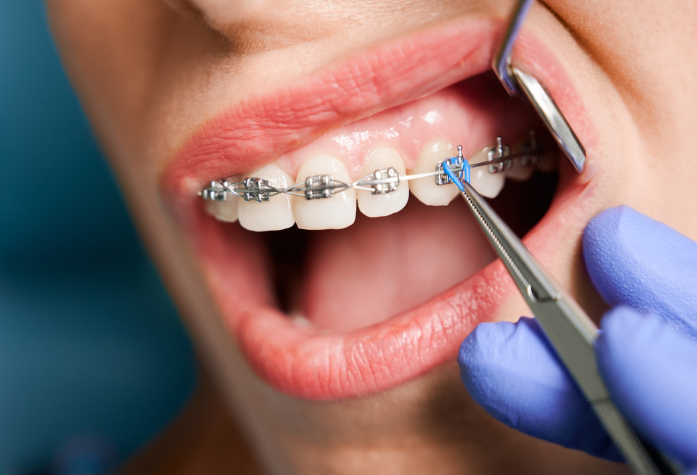 dentist putting blue elastic on a girls braces