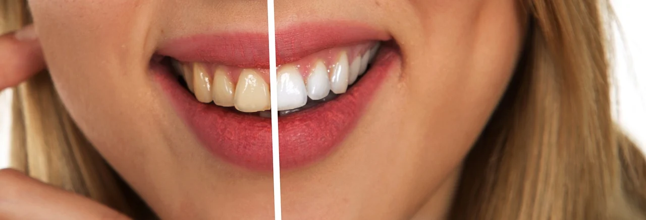 Comparison of a yellowish to a white smile